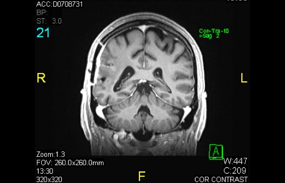 Gliovac after treatment